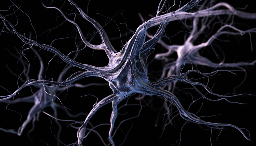 Neurons in Huntington's disease