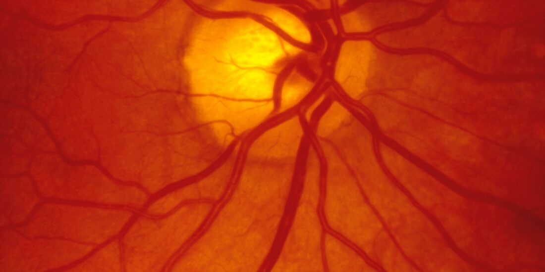 Sigma 2 receptor (σ2R/TMEM97) in Retinal Ganglion Cell Degeneration