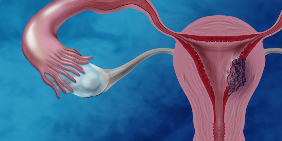 Haloperidol Instigates Endometrial Carcinogenesis and Cancer Progression by the NF-κB/CSF-1 Signaling Cascade