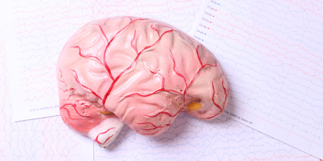 TMEM97 increases in synapses and is a potential synaptic Aβ binding partner in human Alzheimer’s disease